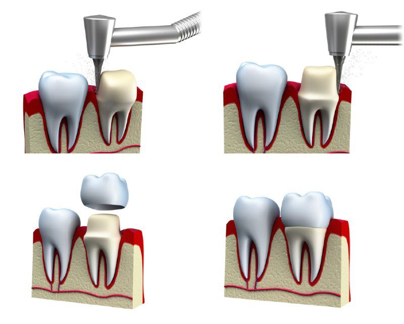 Crown and Bridges Images