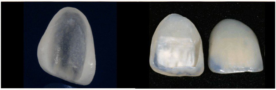Tooth Dental Veneers Images