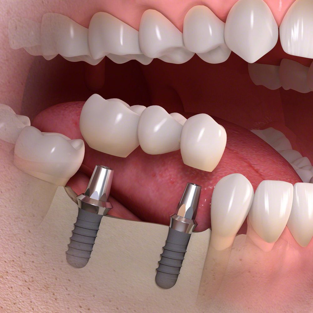 Implant Borne Multi Tooth Images