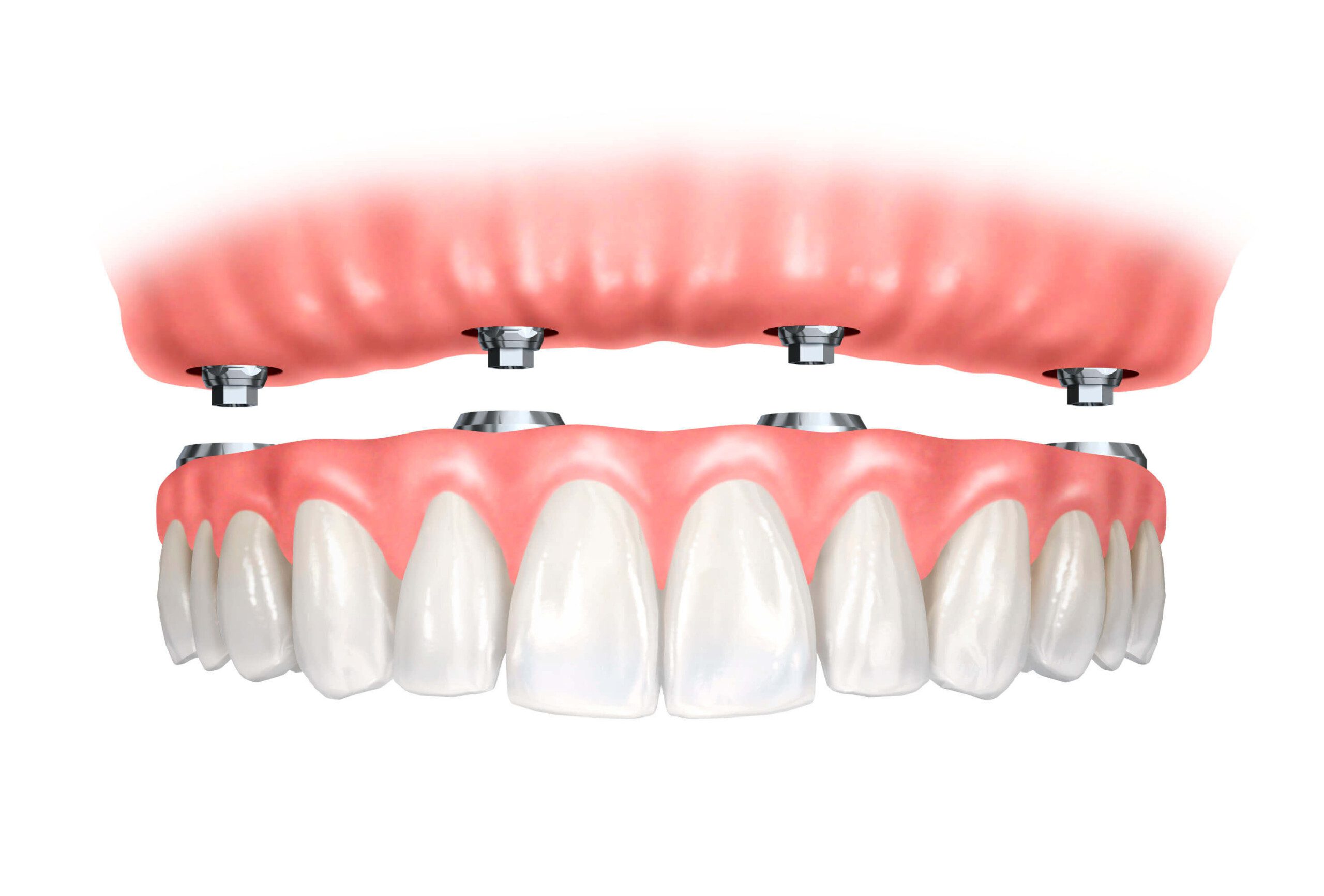 Implant supported fixed dentures Images