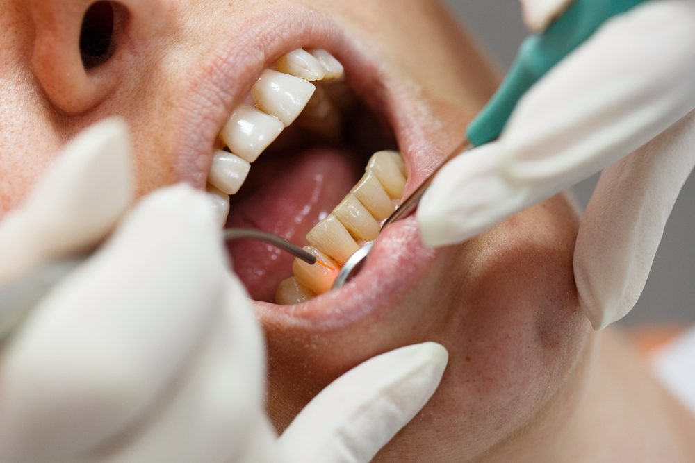 Laser Dentistry Treatment Images