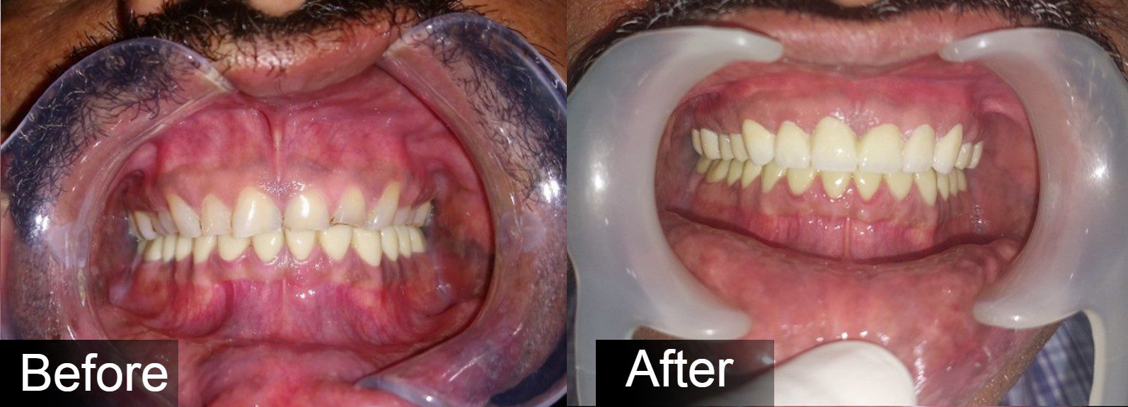 Full Mouth Rehabilitation Images01