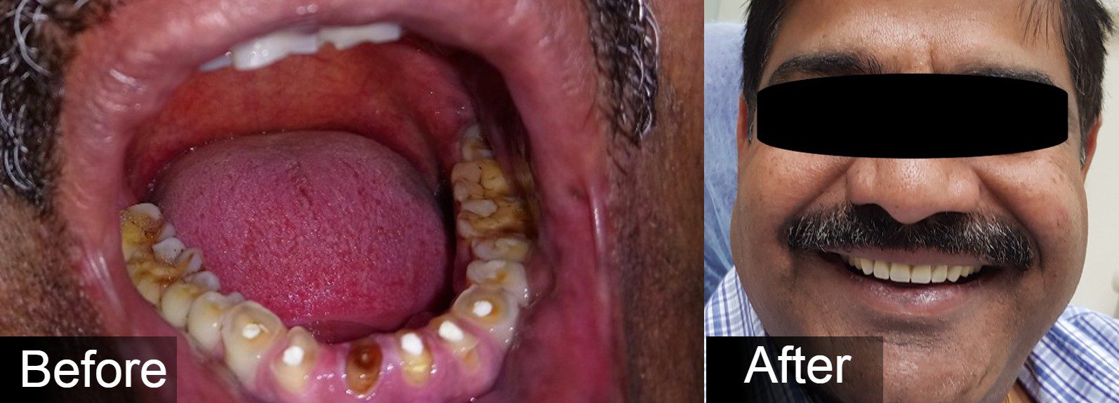 Full Mouth Rehabilitation Images