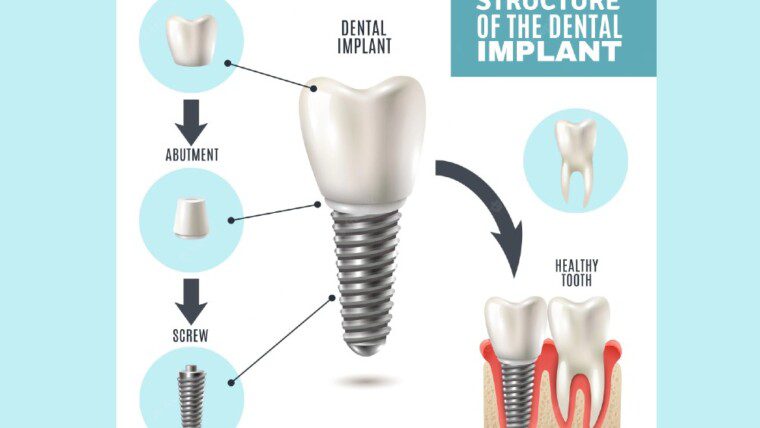 Dental Implants