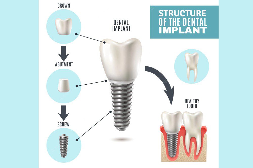 Structural Dental Implant Images