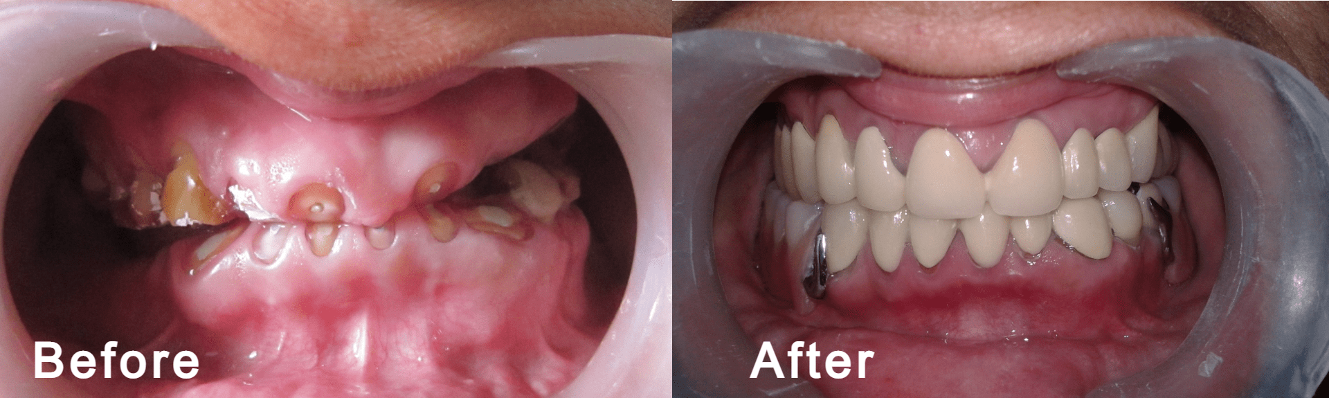 Full Mouth Rehabilitation Images