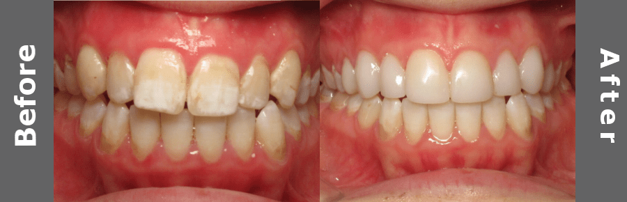 Tooth Cleaning, Laminates And Veneers Images
