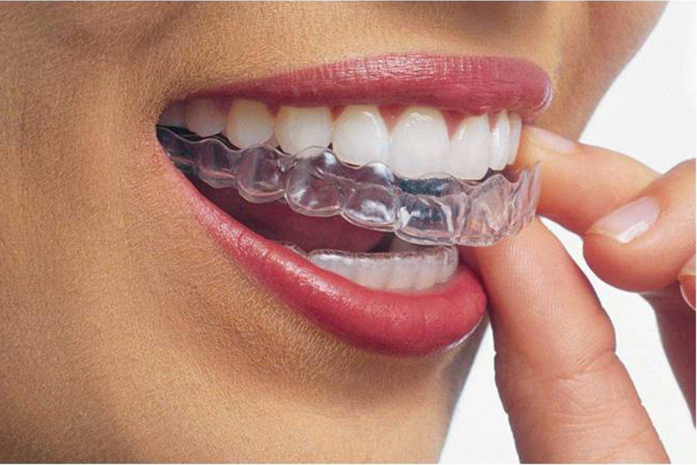 Orthodontic Dental Braces Images