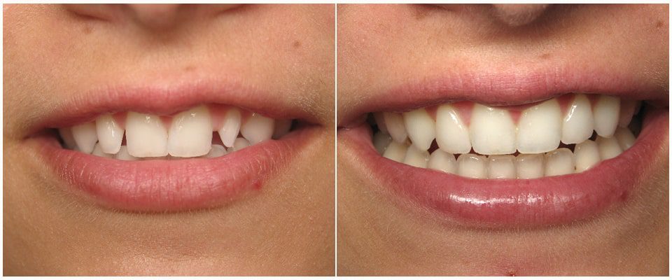 Peg Lateral Teeth Fix Teeth Images