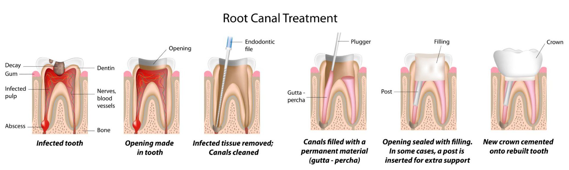 Root Canal Treatment Graphical Image01