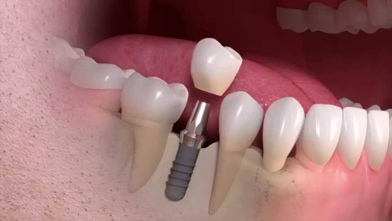 Implant Borne Single Tooth Images