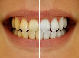 Tooth Cleaning, Laminates And Veneers Images