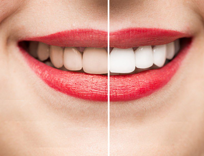Smile & Teeth Whitening Images