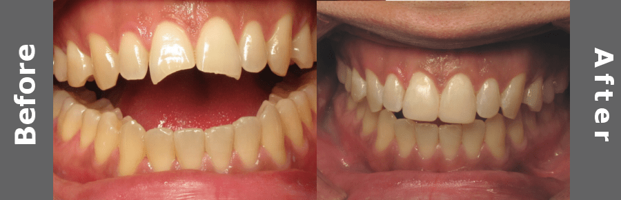 Tooth Laminates And Veneers Images