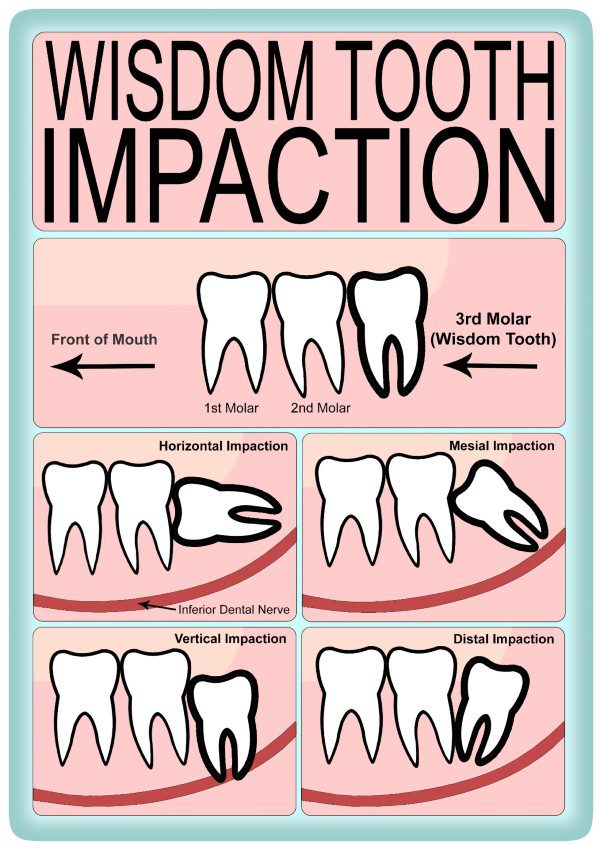 Wisdom Teeth Extraction Images