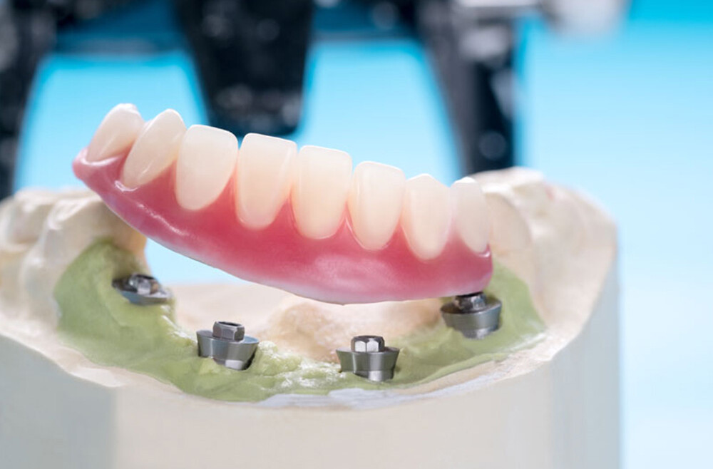Implant-supported dentures have several benefits