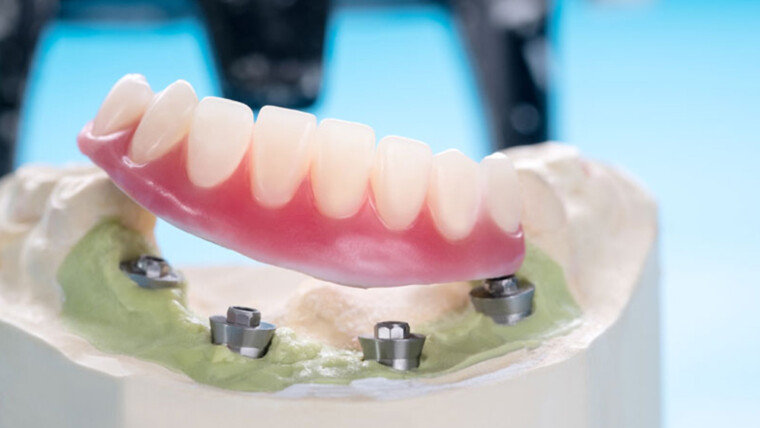 Implant-supported dentures have several benefits