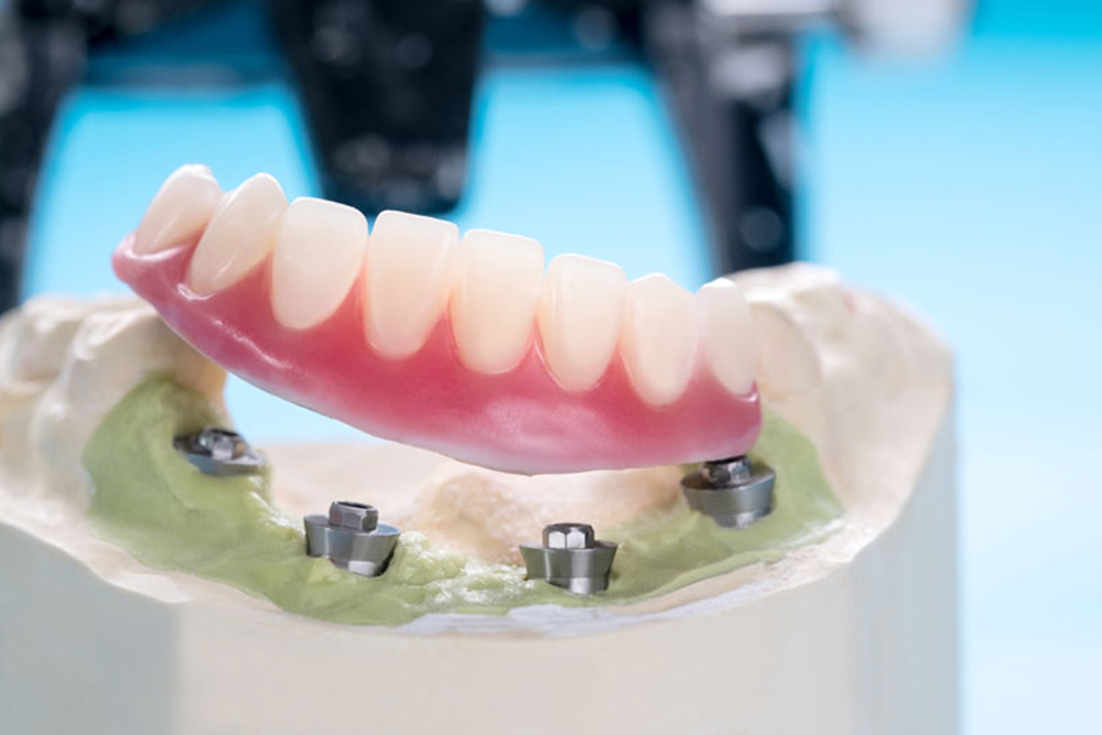 Implant Supported Dentures Images