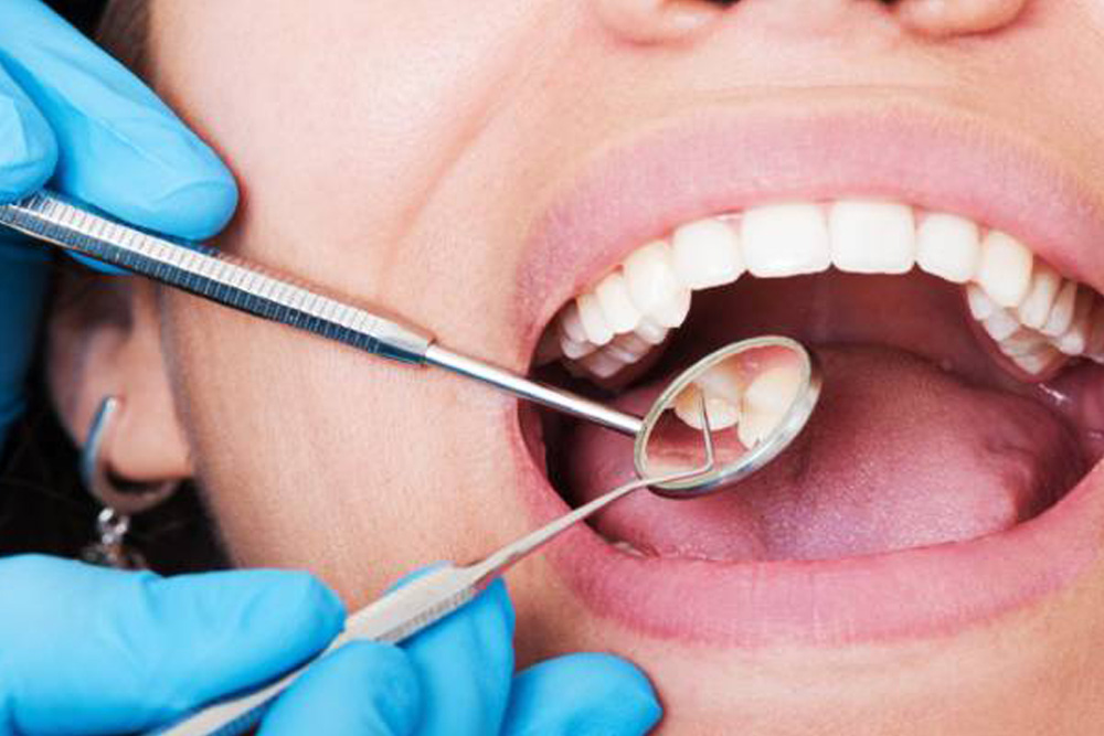 keep your smile with Teeth Cleaning Image