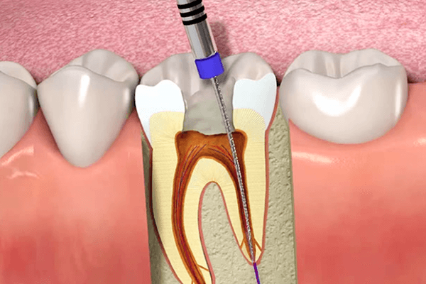 You need to know what root canal treatment is all about?