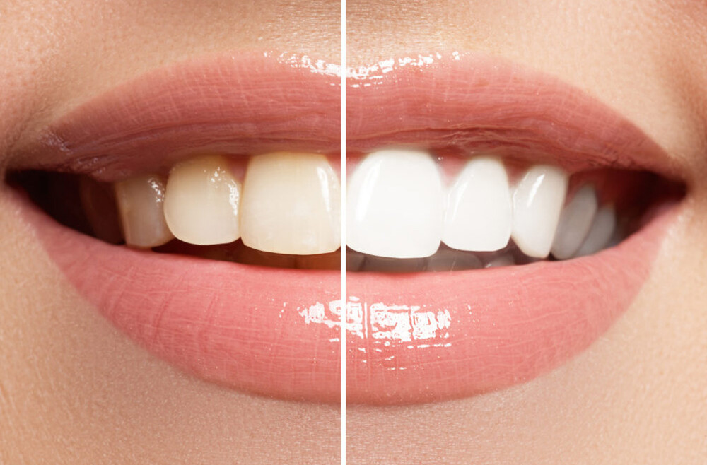 Here are 5 things you should avoid after whitening your teeth