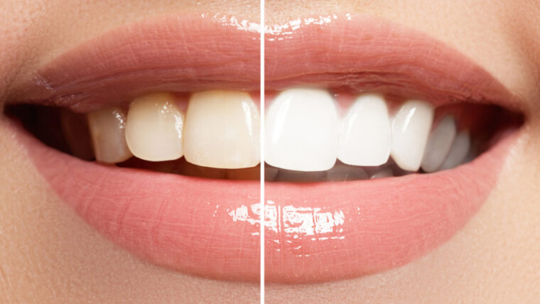 Here are 5 things you should avoid after whitening your teeth
