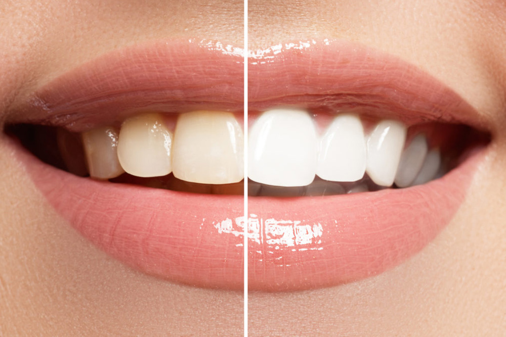 Smile With Teeth Whitening Images