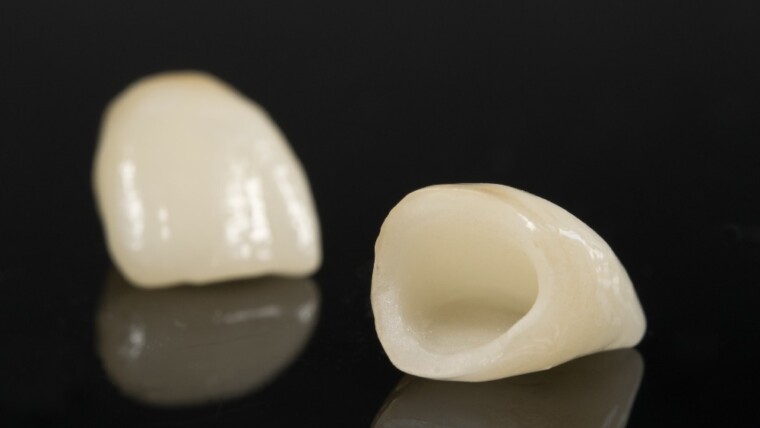 What You Need to Know About Dental Crowns