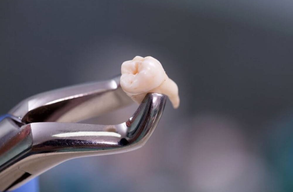This is How Wisdom Teeth Are Removed