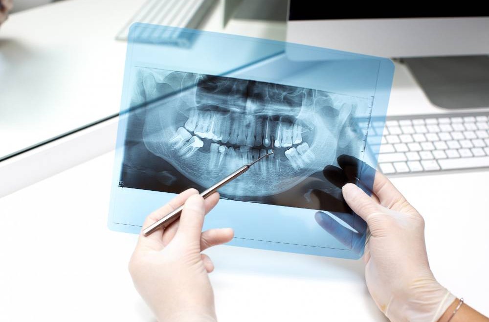 Why Do You Need Dental X Ray
