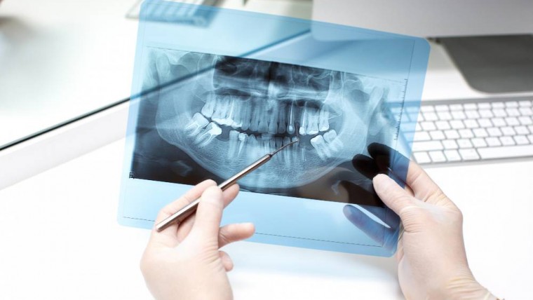 Why Do You Need Dental X Ray
