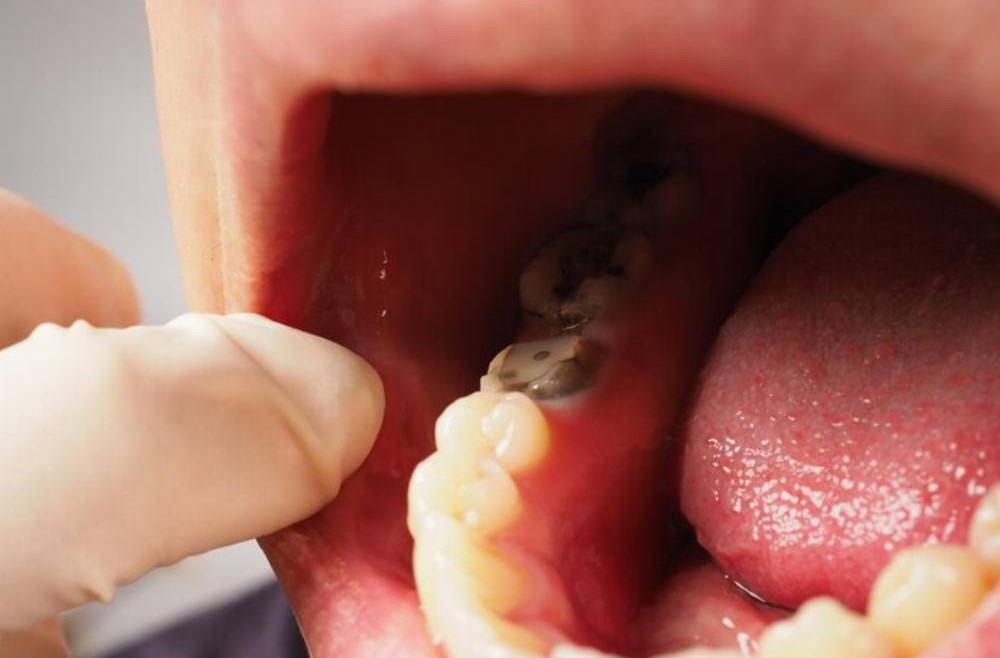 Signs That You May Have a Cavity: Recognizing Dental Decay Early