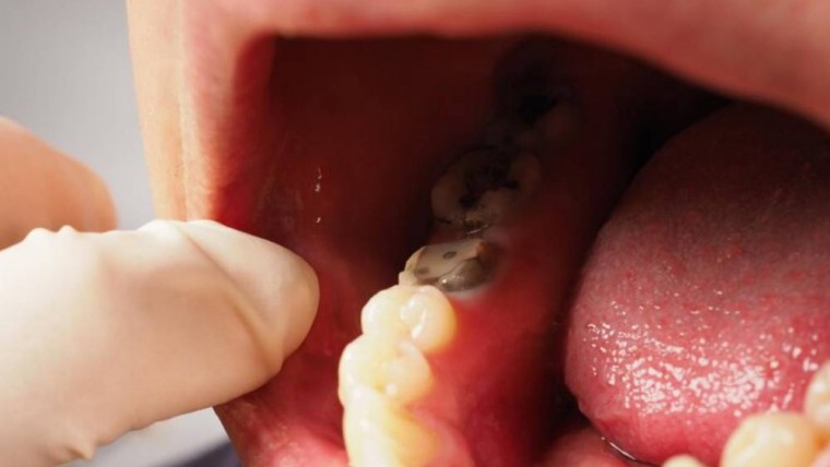 Signs That You May Have a Cavity: Recognizing Dental Decay Early