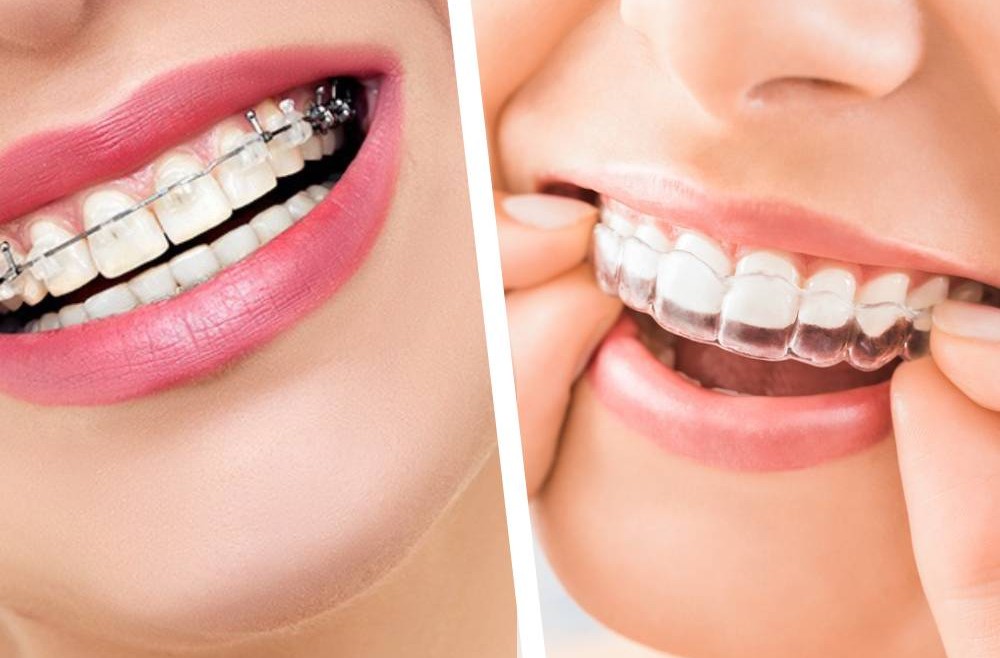 The Benefits of Orthodontic Treatment Beyond Aesthetics.