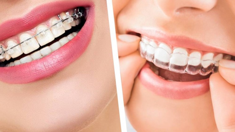 The Benefits of Orthodontic Treatment Beyond Aesthetics.