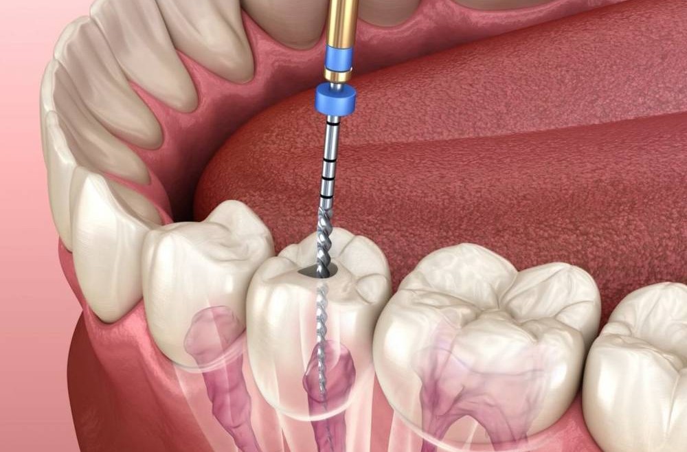 The Best 5 Ways to Support Recovery After a Root Canal
