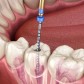 The Best 5 Ways to Support Recovery After a Root Canal